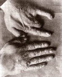 Albert Geyser fue elcreador del Tricho System. Ultilizaba los Rayos X para la depilacion